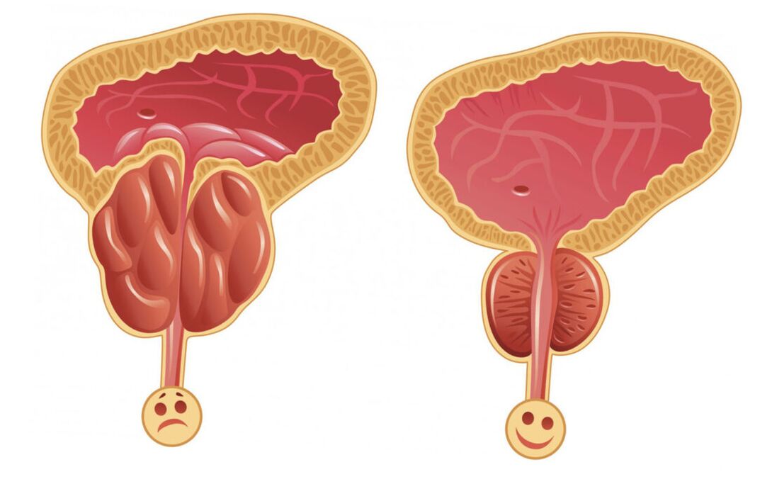 A prosztatagyulladás prosztatagyulladással (balra) és a prosztatamirigy normális (jobbra)