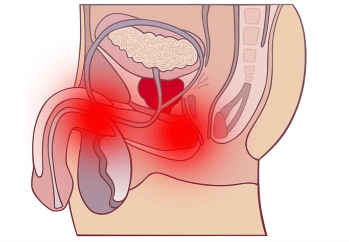 a nemi traktus gyulladása prosztatagyulladással