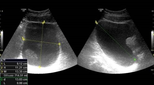 A prosztata ultrahang segít diagnosztizálni a prosztatagyulladást férfiaknál